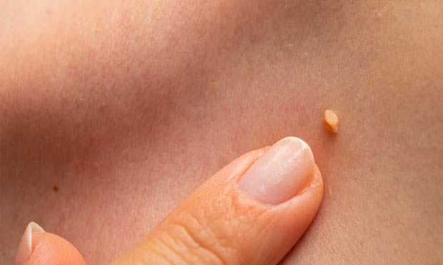 Laser Skin Mole Removal 激光嫩膚與去疣療程